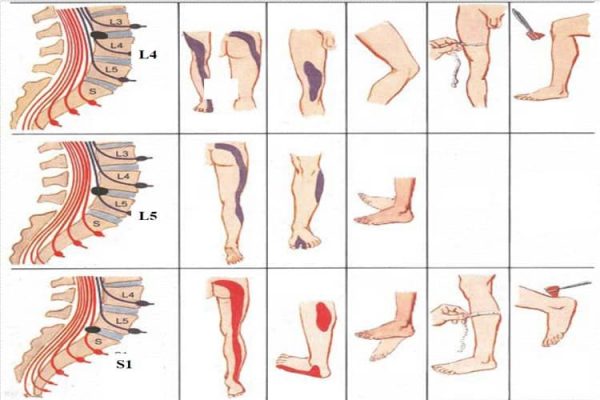 Symptoms Of Sciatica In Hindi