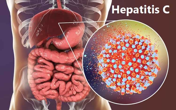 liver-cirrhosis