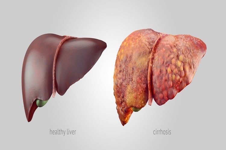 liver-cirrhosis