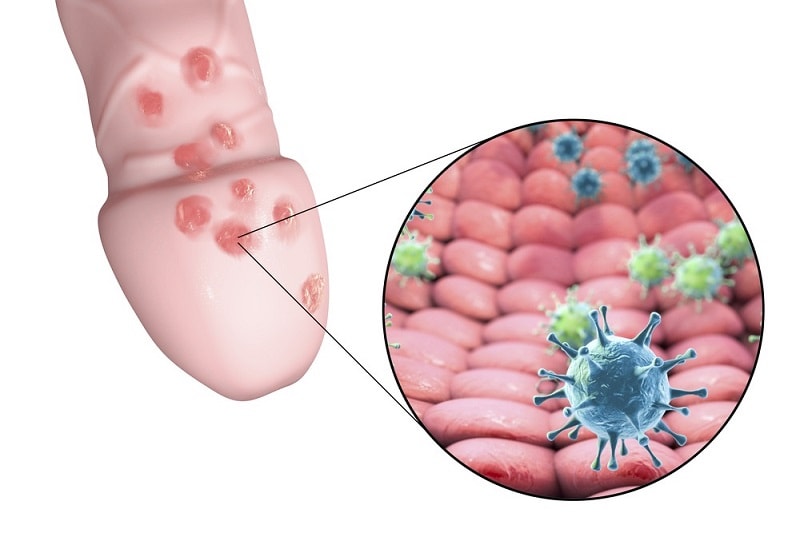 penis-infection-symptoms